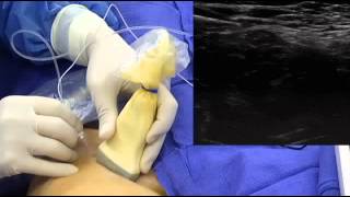 UltrasoundGuided Femoral Nerve Block [upl. by Acinom]