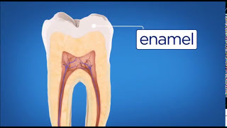 Five stages of Tooth decay [upl. by Ahsiak]