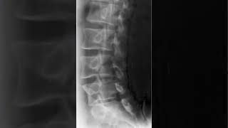 Lumbar Spine Oblique Radiology Tutorial [upl. by Ayar466]