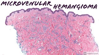 Microvenular Hemangioma 5Minute Pathology Pearls [upl. by Llertniuq812]