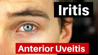 NEET PGUveitis amp Anterior uveitisOphthalmology [upl. by Aznecniv]