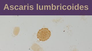 Ascaris Lumbricoides and Ascariasis  Pathology mini tutorial [upl. by Odragde]