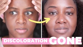 How I Got Rid of My Dark Circles Black Skin [upl. by Jahdol237]