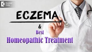 Eczema Causes Symptoms amp Homeopathic Management  Dr Sanjay Panicker  Doctors Circle [upl. by Deys207]