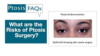 How to Correct Droopy Eyelids with these 3 Easy Eye Exercises [upl. by Yunfei]