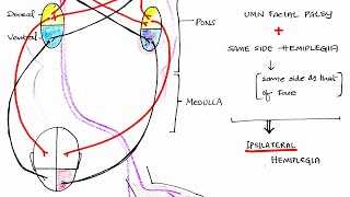 Hemiplegia CVA  Stroke  Theory amp Clinical discussion [upl. by Idnim]