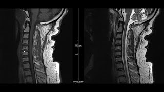 Noncontrast MRI cervical spine search pattern [upl. by Airliah]