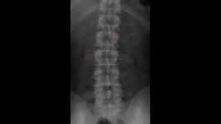 Lumbar Spine Radiology Tutorial [upl. by Sibylle]