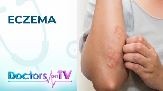 Eczema Symptoms Causes and Treatment  Doctors on TV [upl. by Ellened]