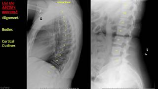 Introduction to Spine Radiographs [upl. by Norbie677]