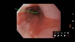 Barretts esophagus  Endoscopy [upl. by Titania]