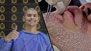 Marcos GARCIA Hair Transplant Beard Transplant  Transplante Capılar  transplantecapilar [upl. by Einyaj64]