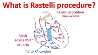 What is Rastelli procedure [upl. by Jepson]