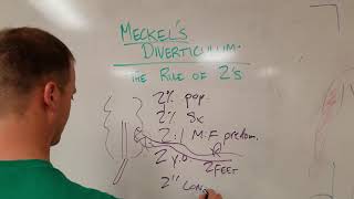 Meckels Diverticulum The Rule of 2s [upl. by Nylsirhc682]