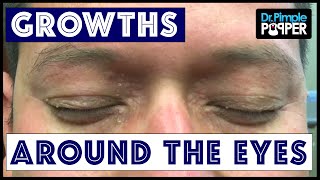 Removing Multiple Different Types of Growths around Eyes [upl. by Nugent]