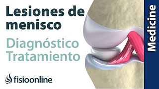 😩😩ROTURA DE MENISCO ► Diagnóstico y tratamiento de fisioterapia médico y quirúrgico [upl. by Adoree]