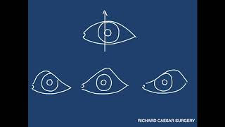 Ptosis Tutorial  A Practical Approach [upl. by Bonar688]