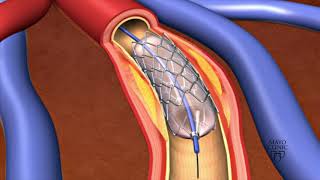 Balloon Angioplasty and Stenting Animation [upl. by Nittirb713]