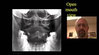 Cervical Spine Xrays [upl. by Yniattirb]