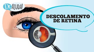 Descolamento de retina  TRATAMENTO SEM CIRURGIA [upl. by Ellenwad]