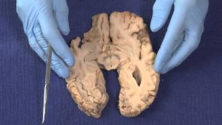 Basal Ganglia Neuroanatomy Video Lab  Brain Dissections [upl. by Kipton]