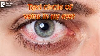 How do I get rid of the orangered circle of veins in my eye  Dr Sriram Ramalingam [upl. by Caesaria]