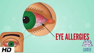 Eye Allergy Causes Signs and Symptoms Diagnosis and Treatment [upl. by Shannen961]