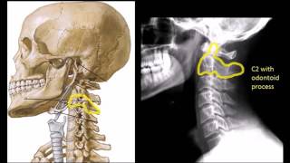 Approach to Cervical spine xrays [upl. by Cavallaro]