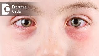 Symptoms of eye allergies  Dr Sriram Ramalingam [upl. by Annola142]