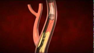 You and Your Stent [upl. by Poppas]