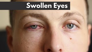 Swollen eyes  EXPLAINED  Dr DOrio Eyecare [upl. by Annahgiel1]