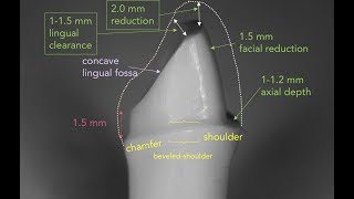 Anterior PFM Preparation  Dr Richard Stevenson [upl. by Harac264]