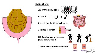 Meckel’s Diverticulum [upl. by Nanis]