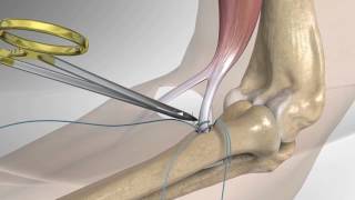 Distal Biceps Repair with Arthrex® Tension Slide [upl. by Othella572]