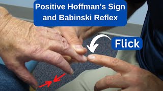 Positive Hoffmans Sign and Babinski Reflex in an MS Patient [upl. by Sine]