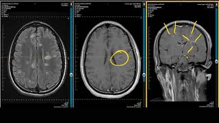 ADC Positive Multiple Sclerosis  Demyelination MRI Case Review [upl. by Hcurob30]