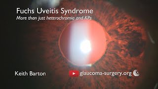 Anterior uveitis posterior uveitis and panuveitis etiology symptoms diagnosis and treatment [upl. by Ffilc373]