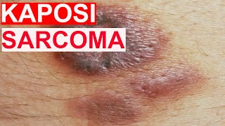 Kaposi Sarcoma [upl. by Idnew]