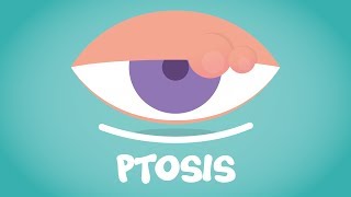 What is Ptosis [upl. by Howlan806]