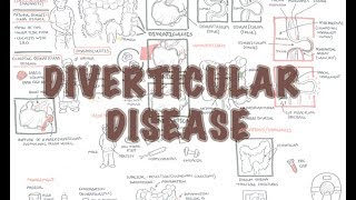 Diverticular Disease diverticulitis  Overview [upl. by Natsyrt]