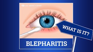 Blepharitis red swollen eyelids Causes Symptoms Treatments [upl. by Ailemor706]