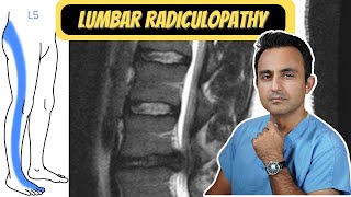 Lumbar Radiculopathy quotSciaticaquot [upl. by Paten]