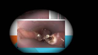 Endoscopic treatment of zenker diverticulum  Russells Hall Hospital [upl. by Strang529]