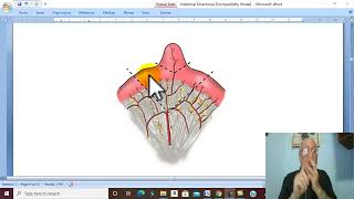 Intestinal Disorders in Arabic 7  Meckels Diverticulum   by Dr Wahdan [upl. by Agretha782]