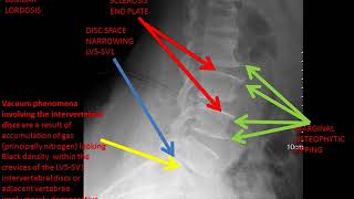 CASE 315 X RAY lumbosacral spine Vacuum phenomena [upl. by Amhsirak]