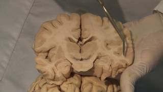 Cortical Localization Neuroanatomy Video Lab  Brain Dissections [upl. by Buseck]