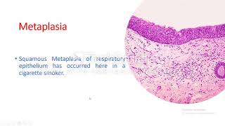 Cellular adaptation Metaplasia [upl. by Oiled]