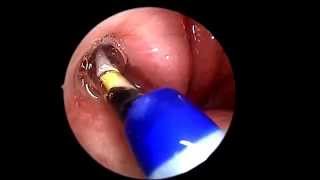 Eustachian Tube Balloon Dilation [upl. by Pages]