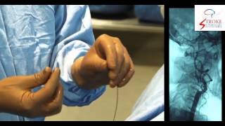 Live Carotid Artery Stenting [upl. by Enelrad]