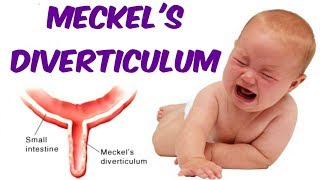 Meckels Diverticulum [upl. by Minardi]